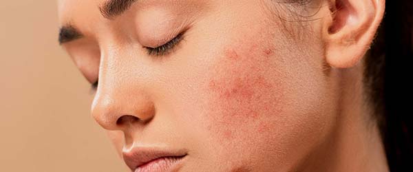 лечения акне 2